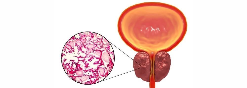 Medical illustration of Benign Prostatic Hyperplasia (BPH) which has many treatments to help you reduce symptoms including TURP and Rezum with Dr. Akash Kapadia